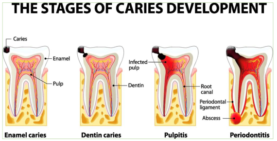 Tooth decay (dental caries)